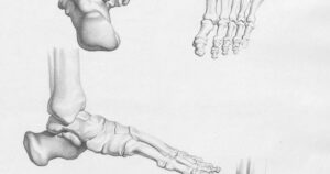 Plantillas ortopédicas 3D para dolor metatarsal
